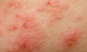 Alergia na sierść psa u dzieci: objawy, które mogą zaskoczyć rodziców
