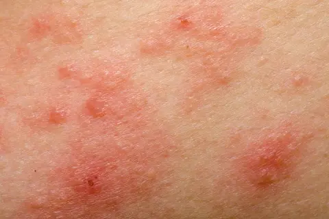 Alergia na sierść psa u dzieci: objawy, które mogą zaskoczyć rodziców