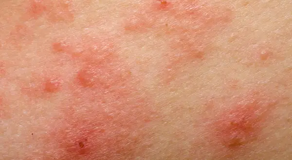 Alergia na sierść psa u dzieci: objawy, które mogą zaskoczyć rodziców