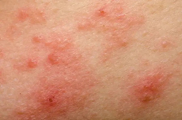 Alergia na sierść psa u dzieci: objawy, które mogą zaskoczyć rodziców